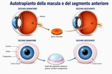 Lo schema del trapianto