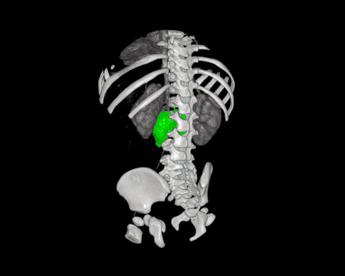 Chirurgia su misura, al Bambino Gesù di Roma rimosso complesso neuroblastoma a bimba di 1 anno