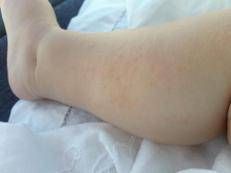 Dermatite atopica - (Adnkronos)