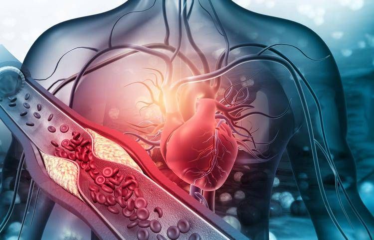 Arterosclerosi, studio: 