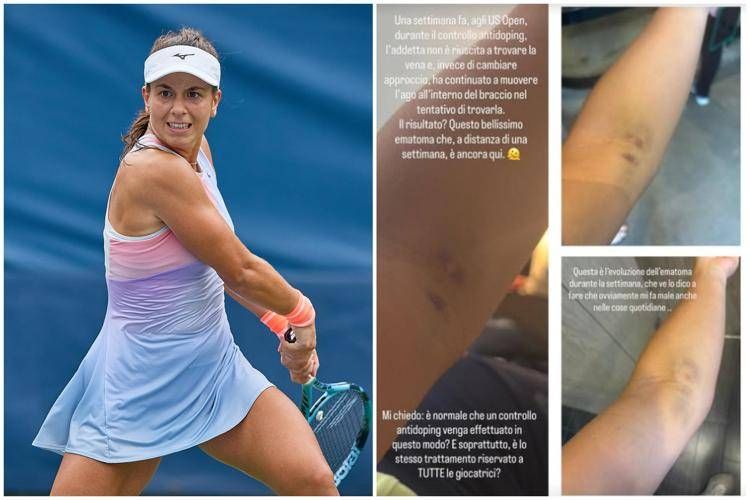 Lucrezia Stefanini e i lividi - Ipa/Fotogramma e Instagram