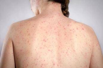 Un caso di morbillo