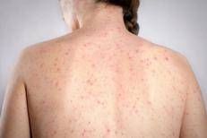 Un caso di morbillo
