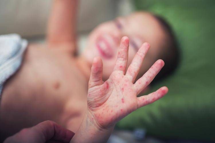 Morbillo, aumentano casi e ricoveri. Bassetti: 