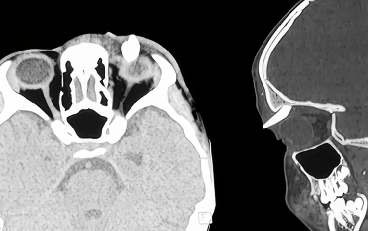 La tac effettuata al ragazzo - (Ophthalmology)
