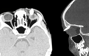 La tac effettuata al ragazzo - (Ophthalmology)