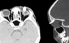 La tac effettuata al ragazzo - (Ophthalmology)