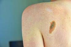 Melanoma - (Foto Adobe)