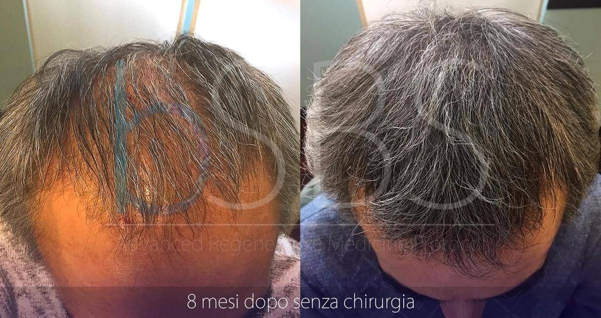 cura per calvizie maschile cura per calvizie maschile