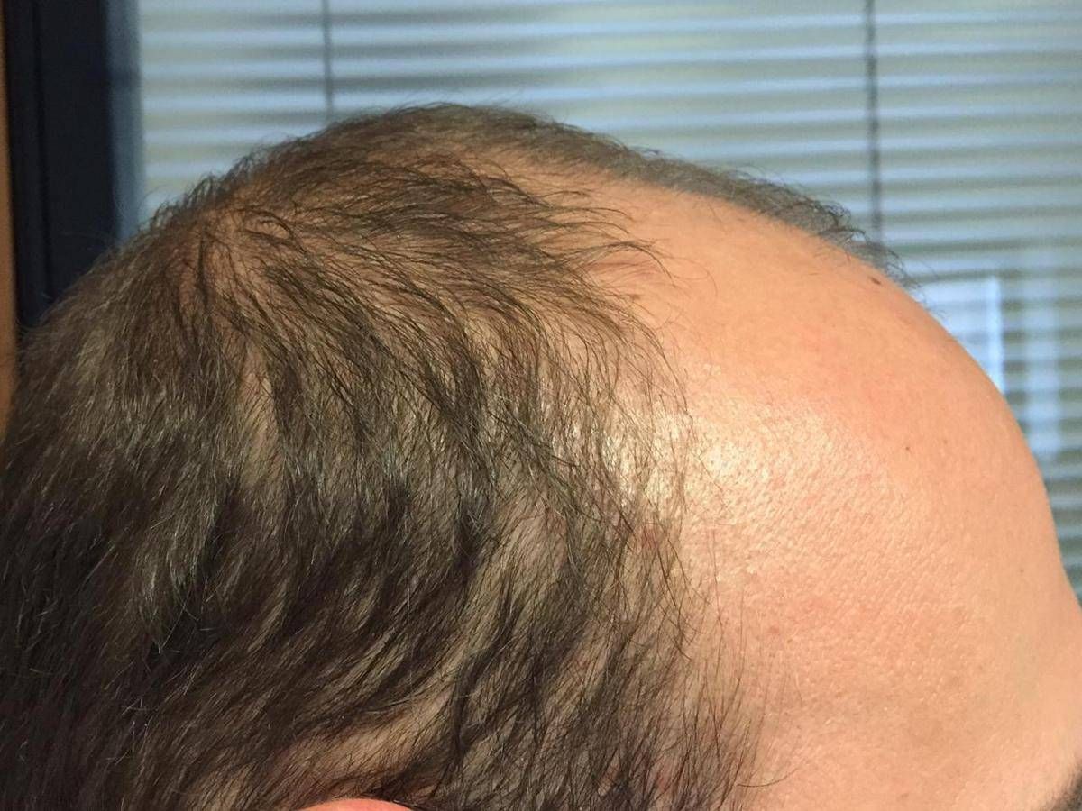 Trapianto Di Capelli Le 7 Cose Da Sapere