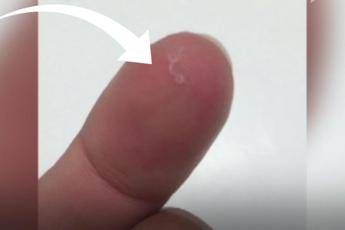 Vermi nell'occhio, cos'è la Thelazia Gulosa Vermi nell'occhio, cos'è la Thelazia Gulosa