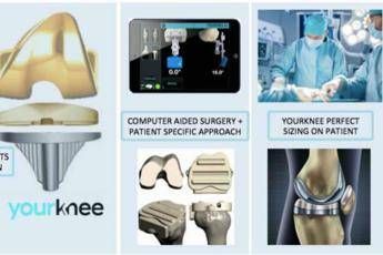 Protesi di ginocchio su misura con 3D e Ai Protesi di ginocchio su misura con 3D e Ai