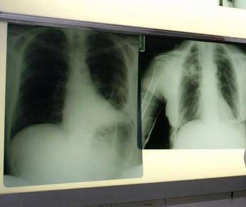Malattie rare, 3mila italiani con ipertensione polmonare Malattie rare, 3mila italiani con ipertensione polmonare