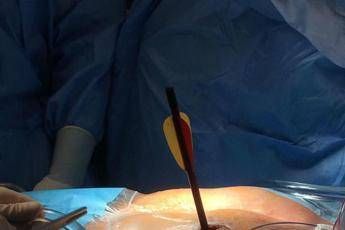 Cuore trafitto da un dardo di 30 centimetri, salvato a Torino Cuore trafitto da un dardo di 30 centimetri, salvato a Torino
