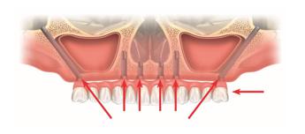 L’implantologia dentale per risolvere l’edentulia