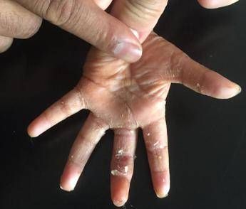 'Impresa' del chirurgo: reimpiantato dito a bimba di 18 mesi 'Impresa' del chirurgo: reimpiantato dito a bimba di 18 mesi