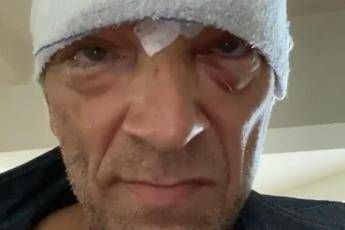 Incidente in moto per Vincent Cassel, l'attore mostra testa bendata e lividi