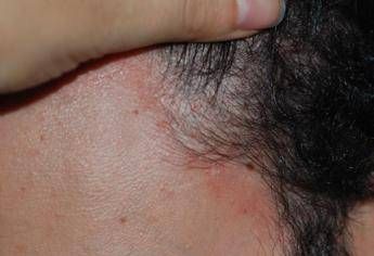 Mascherine per il Covid-19: come evitare che la dermatite seborroica si aggravi Mascherine per il Covid-19: come evitare che la dermatite seborroica si aggravi