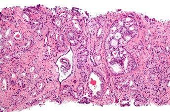 Cancro prostata, metastasi nel 40% dei casi. Cure migliori con la 'pre-chemio' Cancro prostata, metastasi nel 40% dei casi. Cure migliori con la 'pre-chemio'