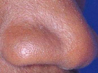 Uomo paralizzato torna a camminare dopo un trapianto di cellule nasali Uomo paralizzato torna a camminare dopo un trapianto di cellule nasali