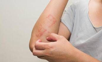 Psoriasi: un corto per superare vergogna, depressione e isolamento Psoriasi: un corto per superare vergogna, depressione e isolamento