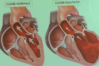 Scompenso killer del cuore, nuova terapia allunga la vita Scompenso killer del cuore, nuova terapia allunga la vita