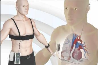 Dal Gemelli cuore artificiale 'wireless', primi pazienti al mondo Dal Gemelli cuore artificiale 'wireless', primi pazienti al mondo