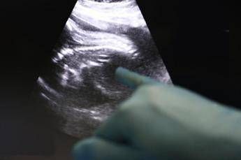 Roma, intervento in utero salva feto di 28 settimane