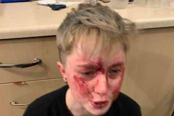 Picchiata perché lesbica, 20enne pubblica foto con volto insanguinato Picchiata perché lesbica, 20enne pubblica foto con volto insanguinato