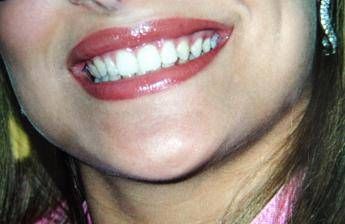 L'apparecchio si deve portare tutta la vita, lo dicono i dentisti L'apparecchio si deve portare tutta la vita, lo dicono i dentisti